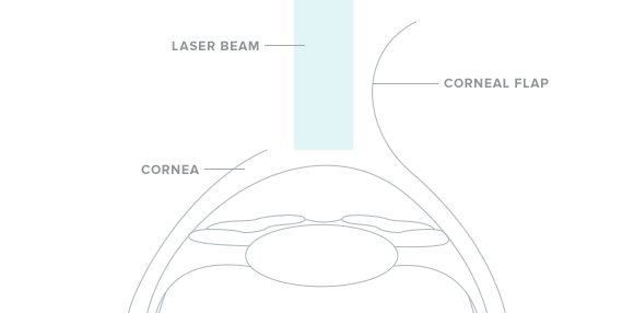 lasik